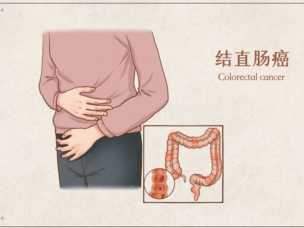 胃肠癌的预防，关键在于早期发现！